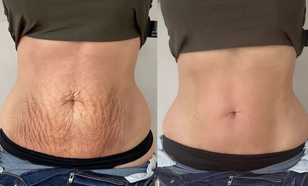 Tighten & Smooth Belly & Stretch Marks Remove Cream