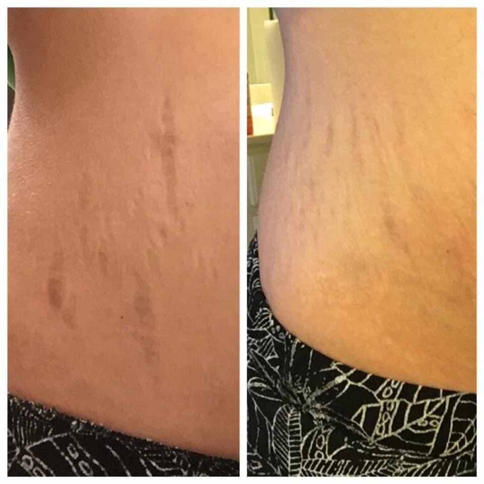 Tighten & Smooth Belly & Stretch Marks Remove Cream