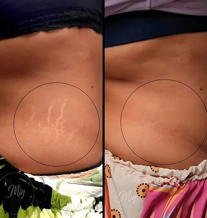 Tighten & Smooth Belly & Stretch Marks Remove Cream