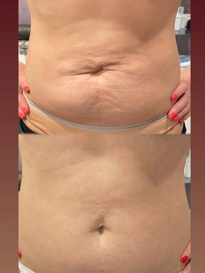 Tighten & Smooth Belly & Stretch Marks Remove Cream