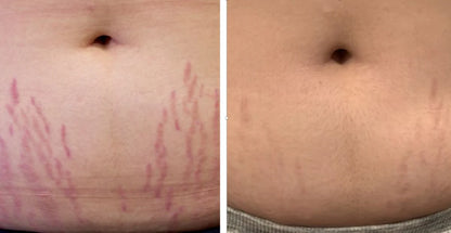 Tighten & Smooth Belly & Stretch Marks Remove Cream