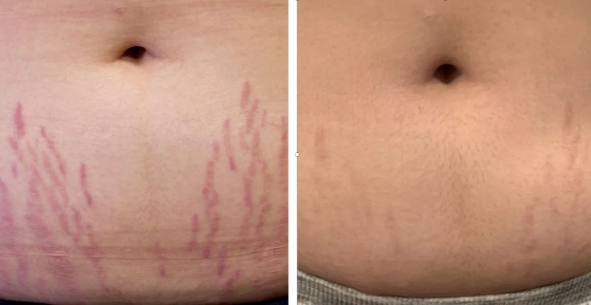 Tighten & Smooth Belly & Stretch Marks Remove Cream