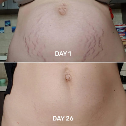 Tighten & Smooth Belly & Stretch Marks Remove Cream
